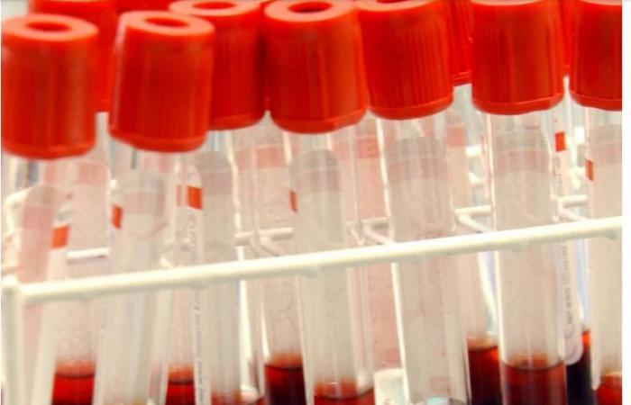 تفاصيل اكتشاف علمى يغير قواعد الزهايمر .. اختبار دم قادر على اكتشاف موت خلايا الدماغ لمن فوق سن الـ 60 خلال 10 أيام بتكلفة 1250 دولارًا ومتاح فى أمريكا وأوروبا فقط