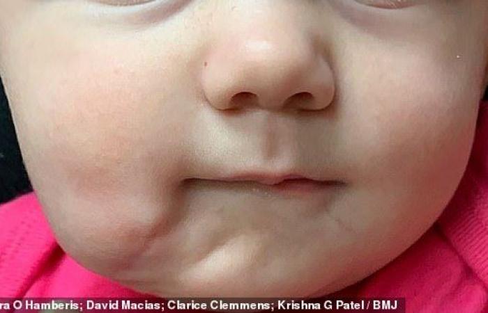 ولادة طفلة "ذات فمين" بالولايات المتحدة.. الحالة النادرة تعد الخامسة والثلاثين منذ عام 1900.. وإجراء عملية جراحية لاستئصال الأسنان والفم الزائد من الوجه.. والطفلة استطاعت تناول الطعام بصورة طبيعية