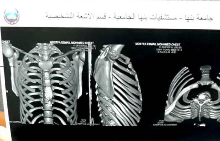 مفاجآت بغرف عمليات مستشفى بنها الجامعى.. استخراج دبوس تنجيد من صدر عامل.. وموبايل من بطن مريض ابتلعه 7 أشهر.. وسنة بالقصبة الهوائية لمسن ابتلعها بالخطأ.. ولمبة عربية وسوكت شاحن وقشرة لب بالقصبة الهوائية لأطفال