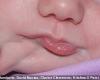 ولادة طفلة "ذات فمين" بالولايات المتحدة.. الحالة النادرة تعد الخامسة والثلاثين منذ عام 1900.. وإجراء عملية جراحية لاستئصال الأسنان والفم الزائد من الوجه.. والطفلة استطاعت تناول الطعام بصورة طبيعية